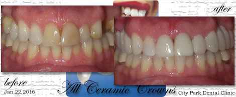 Smile Makeovers:Phuket Dental Clinic